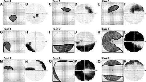 Amsler Grid Visual Field Test: Uses, Procedure, Results .